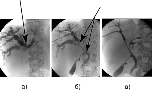 Больной К., 61 год. Аденокарцинома проксимального отдела внепечёночных желчных протоков (опухоль Клатскина)